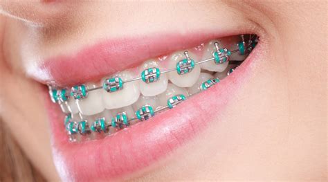 orthodontist braces colors.